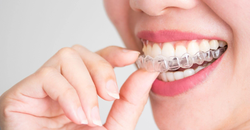 Woman inserting clear aligners to straighten her teeth discreetly