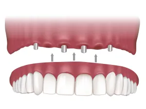 Diagram of implant-supported dentures being secured to dental implants in the upper jaw
