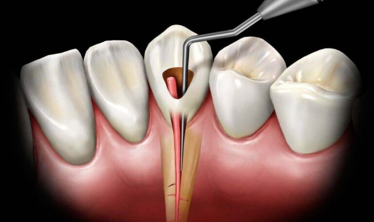Diagram of root canal therapy, showing a dental instrument removing infected pulp from a tooth to save it from extraction