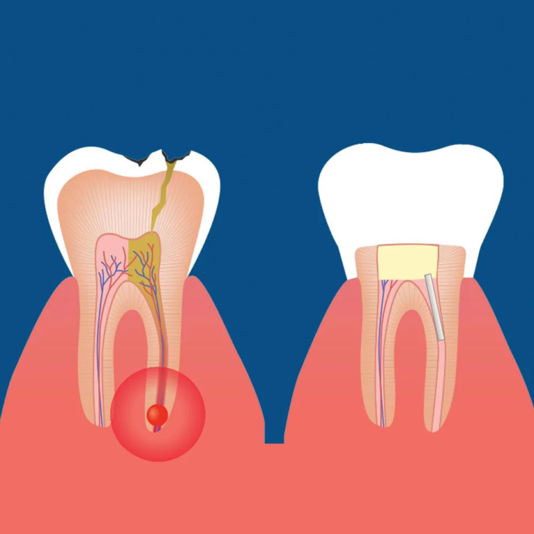 Diagram comparing an infected tooth with an abscess (before root canal) and a tooth after successful root canal therapy with a filling