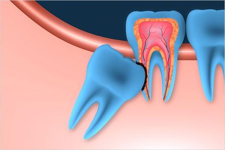Diagram of an impacted wisdom tooth pressing against an adjacent molar, causing damage and the need for extraction