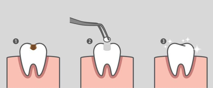 Three-step diagram showing dental filling treatment: removing tooth decay, applying filling material, and restoring the tooth to health