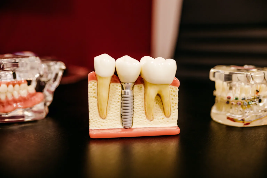 Dental implant model with a titanium screw replacing a missing tooth root, alongside adjacent natural teeth and orthodontic models in the background