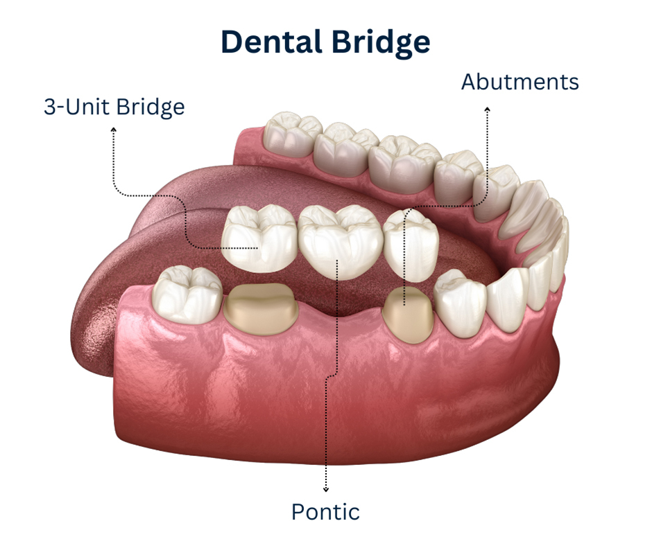 3-unit dental bridge diagram showing abutments and pontic for tooth replacement